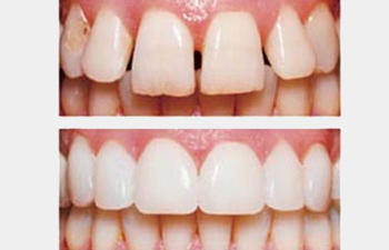 teeth before and after dental tratments at Rocky Hill, CT Dentist