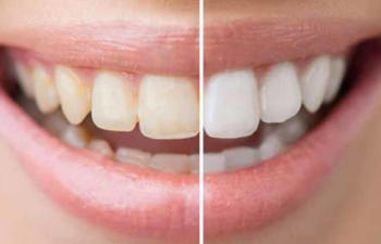 teeth before and after whitening