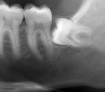 dental X-ray showing horizontal wisdom tooth impaction