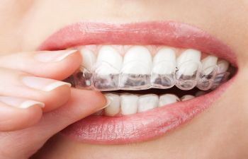 a person putting a dental clear aligner on the upper teeth