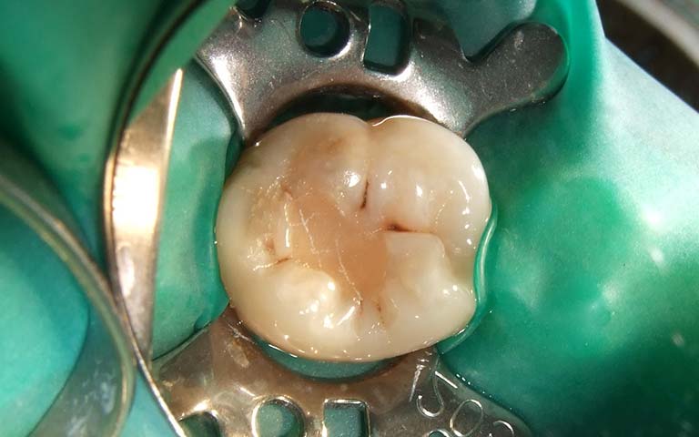 applying dental filling procedure