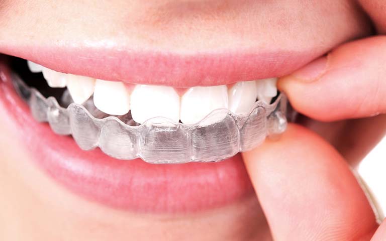 a person putting an Invisalign aligner on the upper teeth