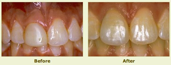 teeth before and after porcelain crowns application