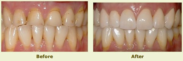teeth before and after porcelain crowns application