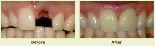 teeth before and after restorative treatment