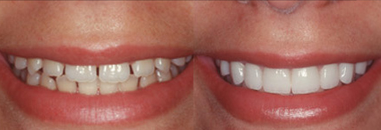 teeth before and after applying venners