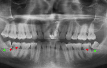 dental X-ray showing wisdom teeth impaction