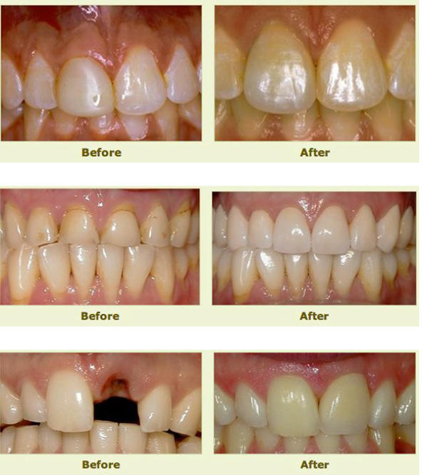 Teeth before and after dental restorative treatment