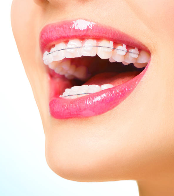 woman's teeth with dental braces