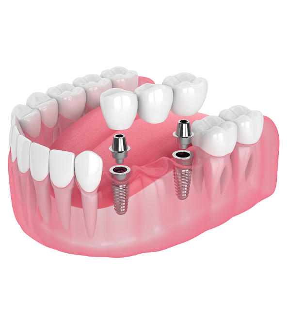 dental bridge