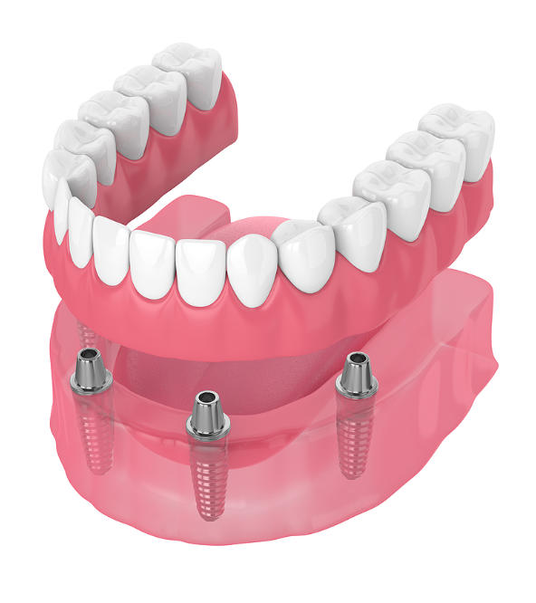 full dental bridge