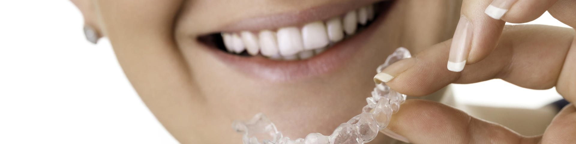 Invisalign aligner