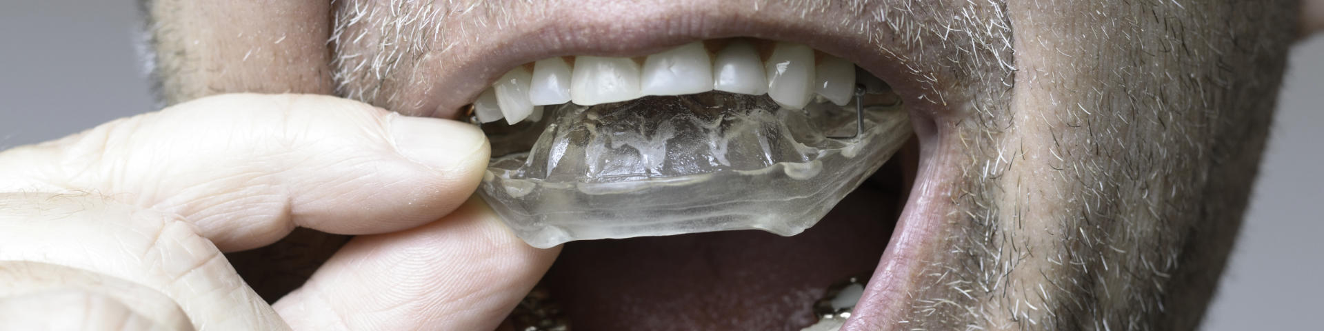 Man inserting night guards for bruxism into his mouth.