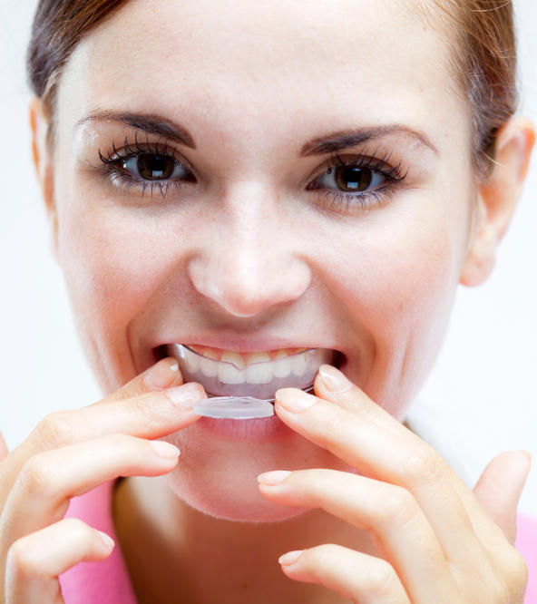 Woman inserting night guards for bruxism into her mouth.