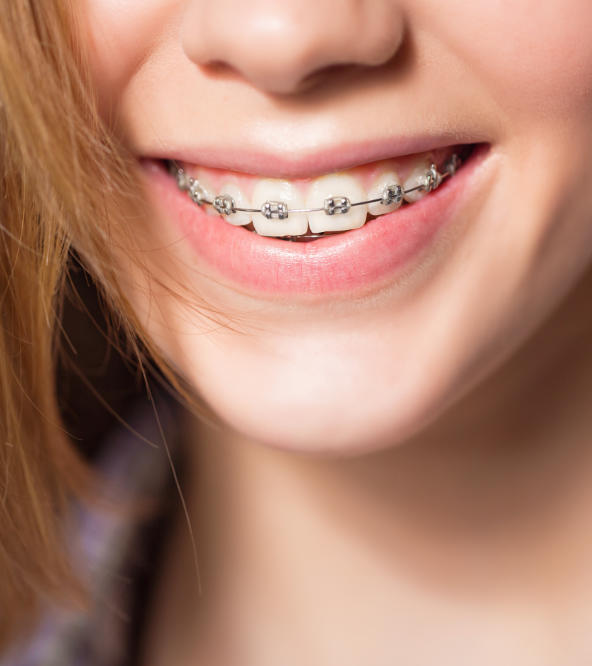 Teenage girl wearing orthodontic braces.