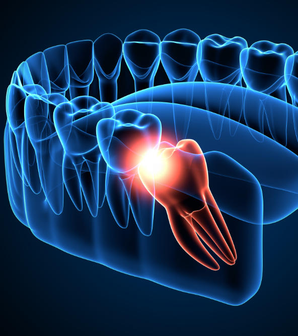 impacted wisdom tooth