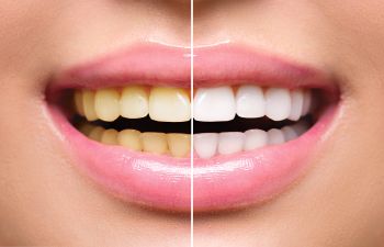 A smiling girl holdin a dental model with traditional braces in one hand and a clear aligner in the other.